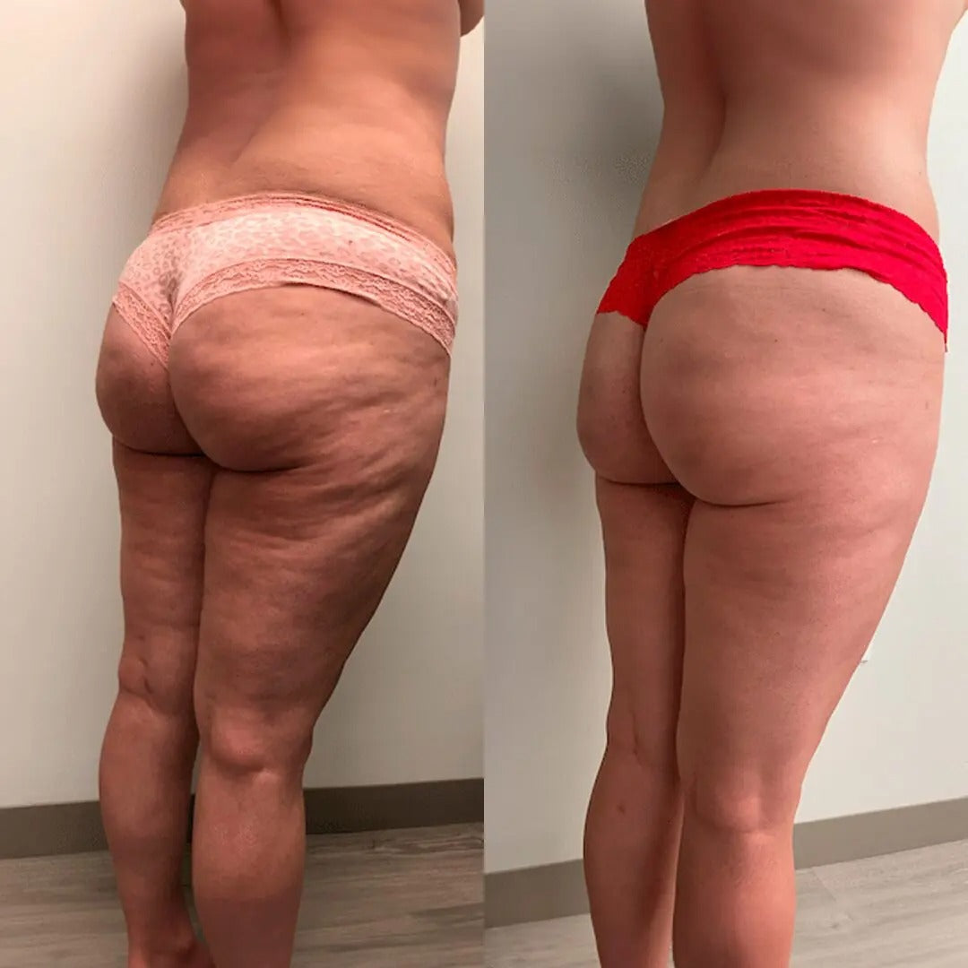 Cryo Thermo™ Gel Firmador