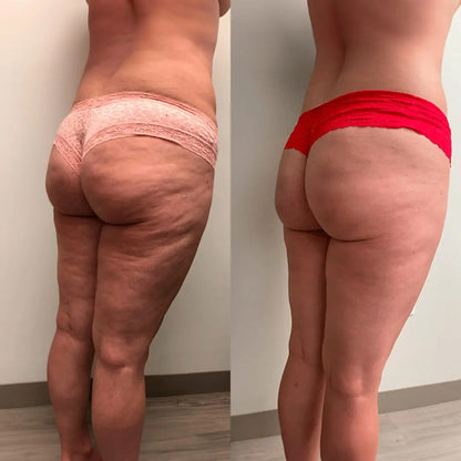 Cryo Thermo™ Gel Firmador